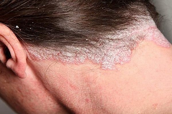 Các loại dầu gội trị vảy nến da đầu tốt nhất dành cho bệnh nhân 