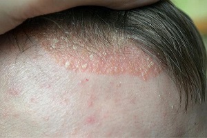 Bệnh vảy nến da đầu: Thông tin và cách trị bằng thuốc nhẹ nhàng 