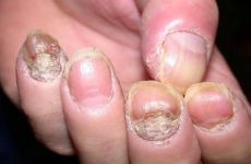 Vảy nến móng tay: Kiến thức bệnh và thuốc bôi điều trị tránh bị hư 