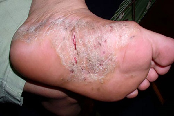 Bệnh vảy nến ở chân là như thế nào và cách trị vảy cá ở chân tại nhà 