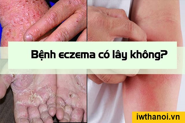 Bị bệnh eczema có lây không và liệu có di truyền nhiều đời không? 