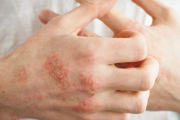 Bị bệnh eczema có lây không và liệu có di truyền nhiều đời không? 