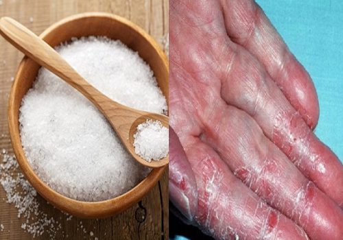 Cách chữa tổ đỉa bằng muối giúp sát trùng diệt khuẩn nhanh khỏi 