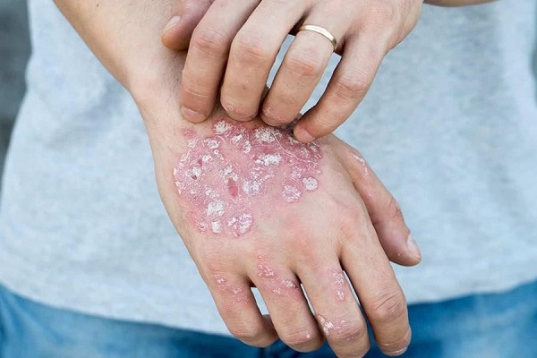 Bệnh eczema là gì? Nguyên nhân, triệu chứng và cách điều trị tốt nhất 