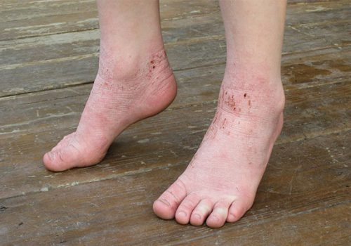 Bệnh tổ đỉa ở chân: Đặc điểm và thuốc chữa trị ở bàn chân 