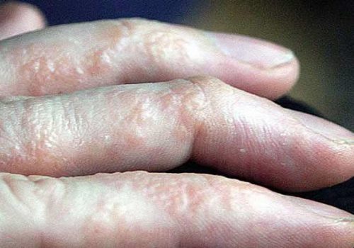 Bệnh tổ đỉa ở tay: Cách nhận biết và thuốc chữa ở bàn tay, ngón tay 