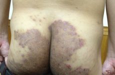 Bệnh hắc lào ở mông: Nhận biết và thuốc trị nấm da ở mông 