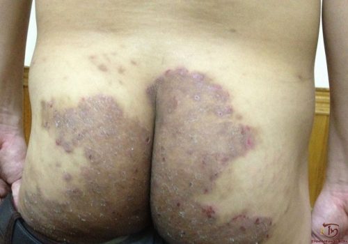 Bệnh hắc lào ở mông: Nhận biết và thuốc trị nấm da ở mông 
