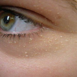 Tìm hiểu nguyên nhân gây bệnh là cách trị mụn gạo quanh mắt, mí mắt hiệu quả nhất 
