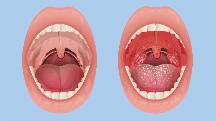Viêm họng là gì? Hình ảnh, Triệu chứng, nguyên nhân và thuốc chữa trị 