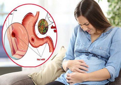 Bà bầu đau dạ dày khi mang thai 3 tháng đầu, 3 tháng cuối phải làm sao? 