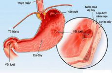 Viêm xung huyết hang môn vị: Kiến thức tổng quan và cách xử lý bệnh 