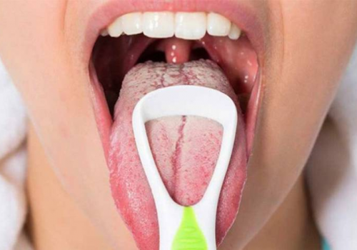 Viêm họng rêu lưỡi trắng trong miệng trông kinh làm thế nào? 