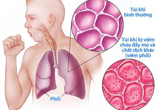 Viêm phổi có sốt không hay không sốt, sốt mấy ngày? 