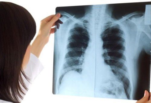 Hình ảnh X quang viêm phổi có ý nghĩa gì? Cách chụp và giá tiền 