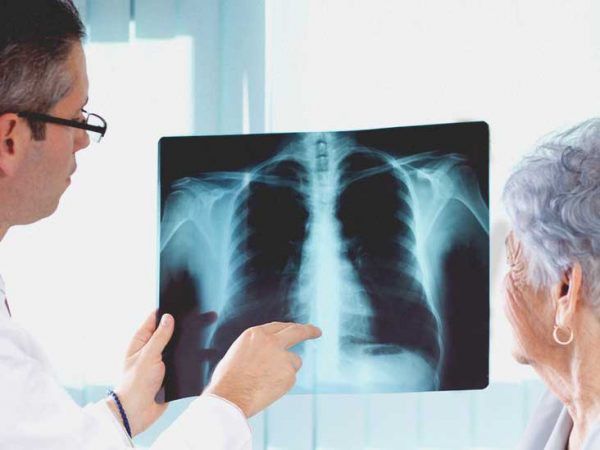 Phác đồ điều trị viêm phổi 2017, 2018 của Bộ Y Tế 