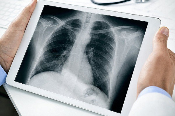 Hình ảnh X quang viêm phổi có ý nghĩa gì? Cách chụp và giá tiền 