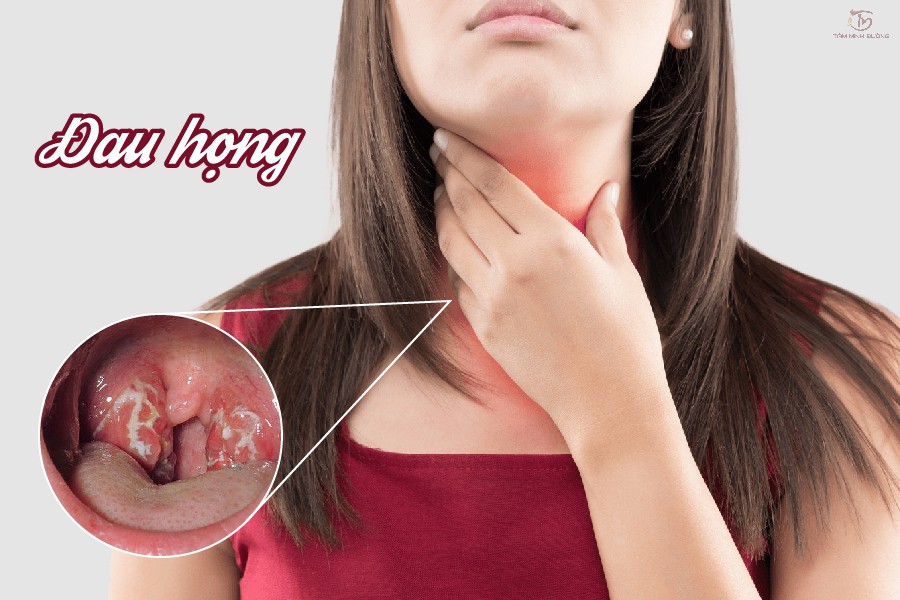 Đau họng là gì? Triệu chứng, nguyên nhân và thuốc chữa bệnh 
