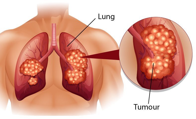 Viêm phế quản phổi: Hình ảnh x quang, đối tượng và phòng tránh biến chứng 