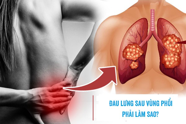Đau sau lưng vùng phổi trái, phải là bệnh gì, liên quan hô hấp không? 