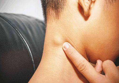 Nổi hạch sau gáy có đau hay không đau và phải làm như thế nào? 