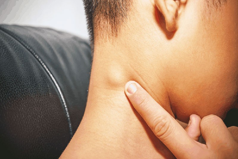 Nổi hạch sau gáy có đau hay không đau và phải làm như thế nào? 