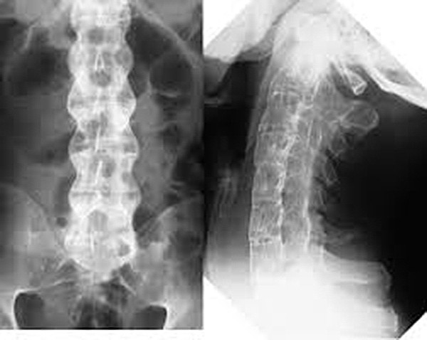Hình ảnh X-quang thoái hóa cột sống cổ, thắt lưng rõ nét, chi tiết 