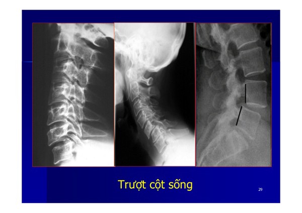 Hình ảnh X-quang thoái hóa cột sống cổ, thắt lưng rõ nét, chi tiết 