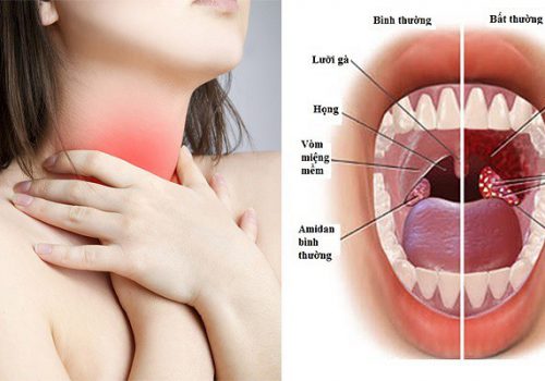 Viêm họng xuất tiết ho ra máu: Hậu quả và những việc cần làm 