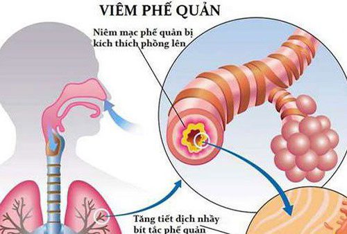Viêm phế quản phổi: Hình ảnh x quang, đối tượng và phòng tránh biến chứng 