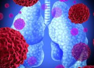 Viêm phổi hít sặc: Đặc điểm, bệnh học và thông tin liên quan 