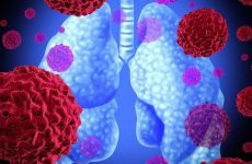 Viêm phổi hít sặc: Đặc điểm, bệnh học và thông tin liên quan 