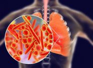 Viêm phổi thùy có lây không? Bệnh học và đối tượng mắc bệnh 