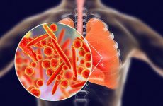 Viêm phổi thùy có lây không? Bệnh học và đối tượng mắc bệnh 