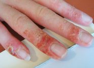 Bệnh chàm khô đầu ngón tay làm thế nào, bị ở tay có hết sạch không? 