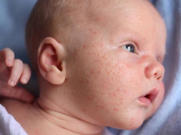 Bệnh chàm sữa ở trẻ sơ sinh lên ở mặt, người như thế nào, tắm lá gì? 