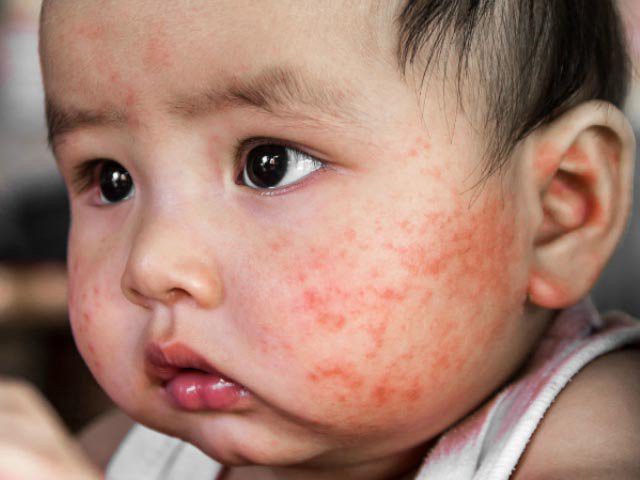 Viêm da liên cầu, tụ cầu khuẩn ở trẻ em có gây nguy hiểm cho các bé? 