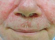 Viêm da tiết bã nhờn ở mặt và thuốc trị hết sạch chất nhờn 