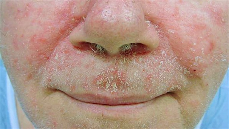 Viêm da tiết bã nhờn ở mặt và thuốc trị hết sạch chất nhờn 